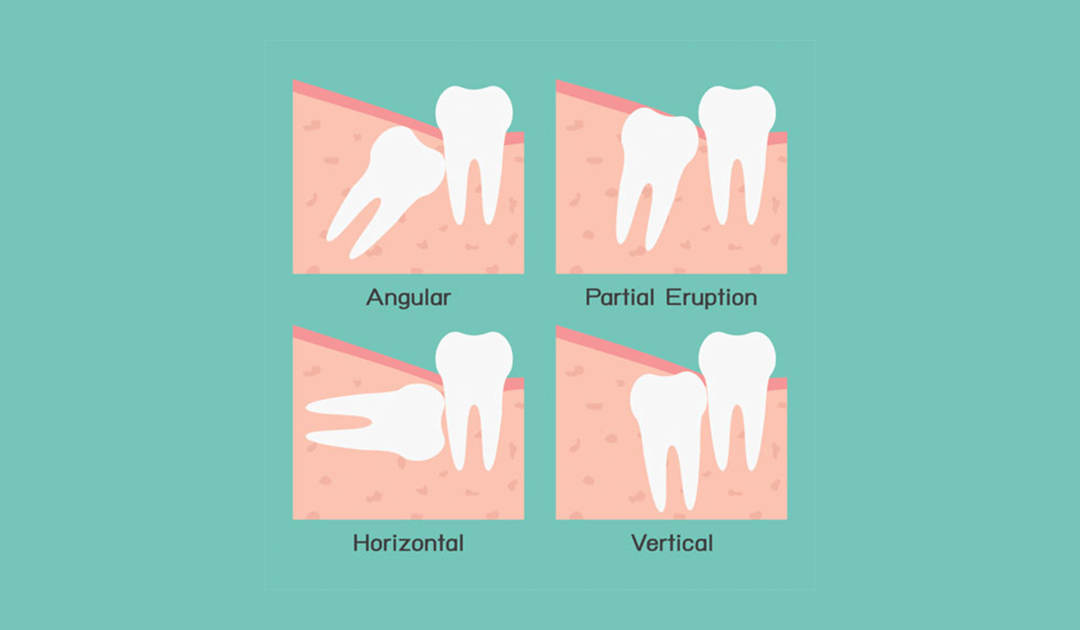 Dental-Extractions