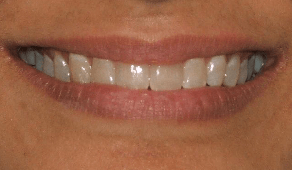 Ortho-After