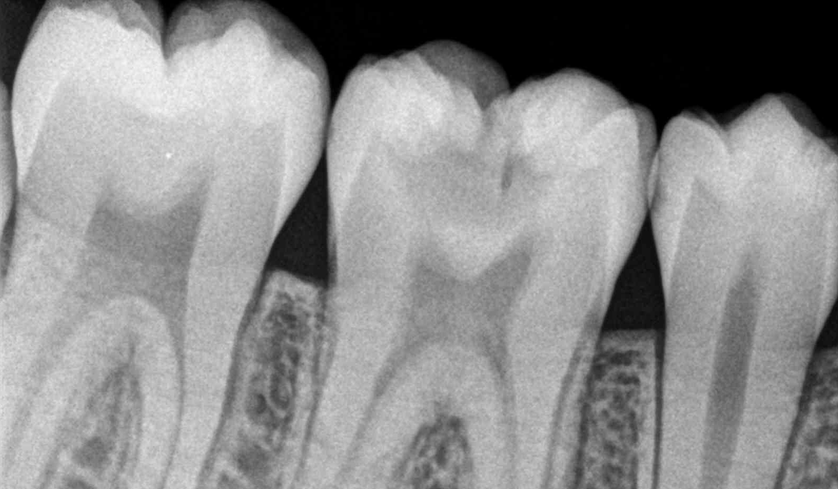 Root-Canal-Treatment-1