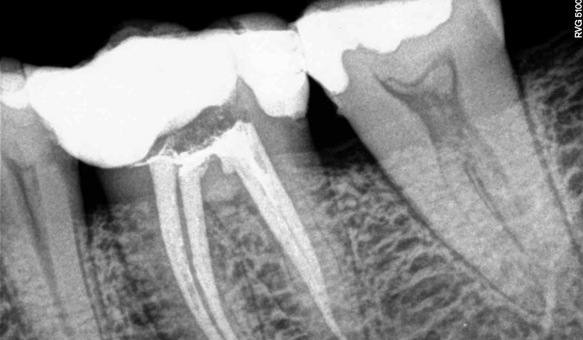 Root-Canal-Treatment-2