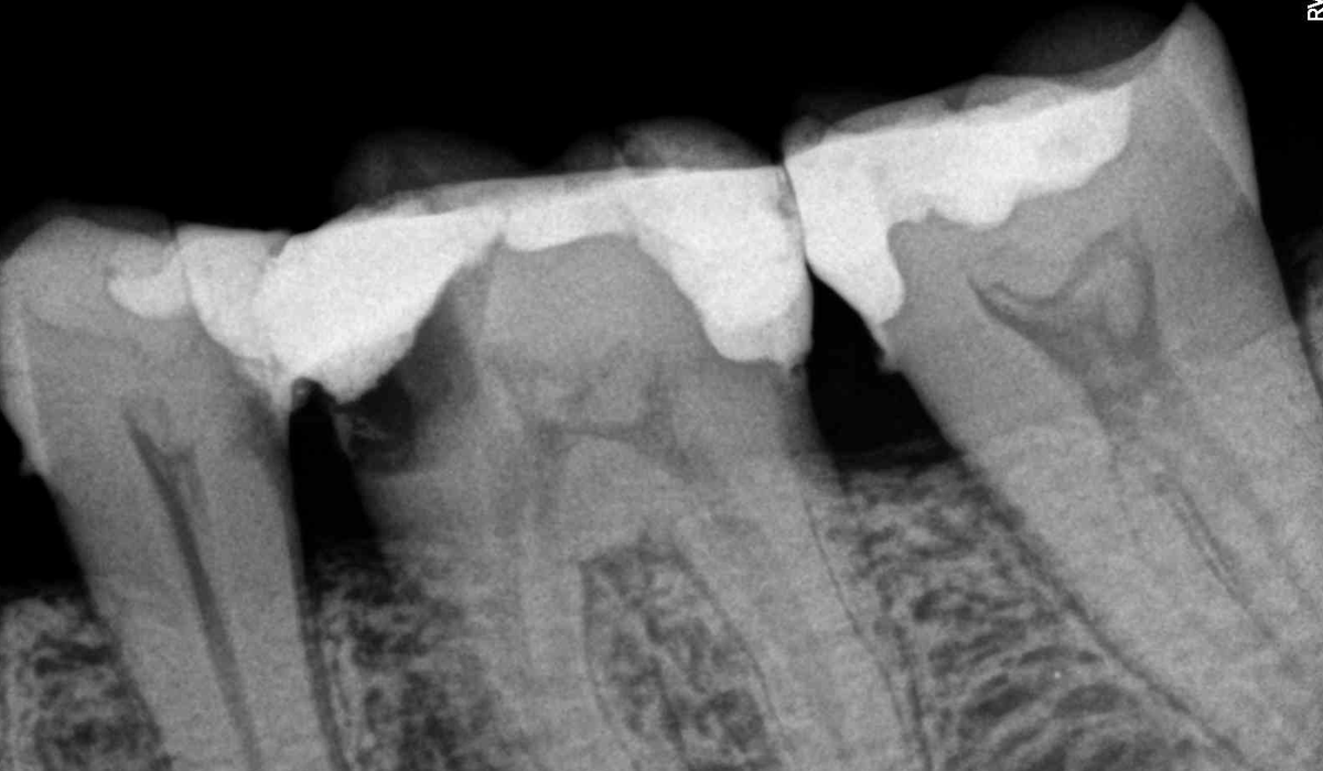 Root-Canal-Treatment-4