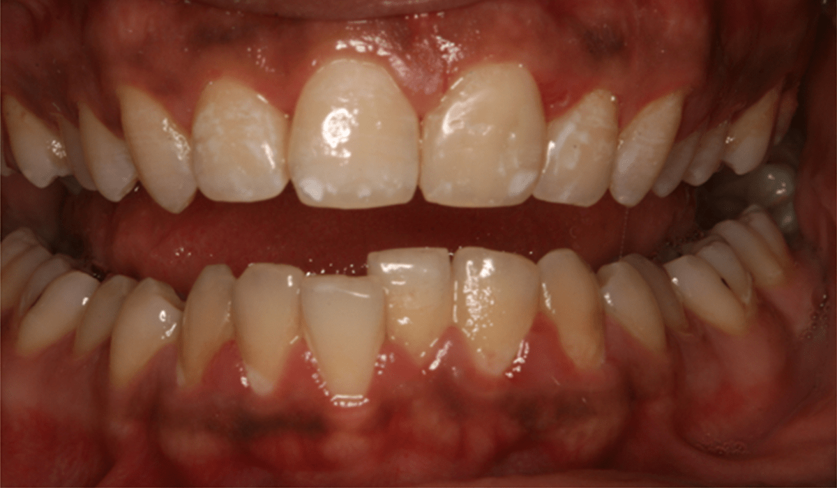 Tooth-Colored-composite-fillings-1