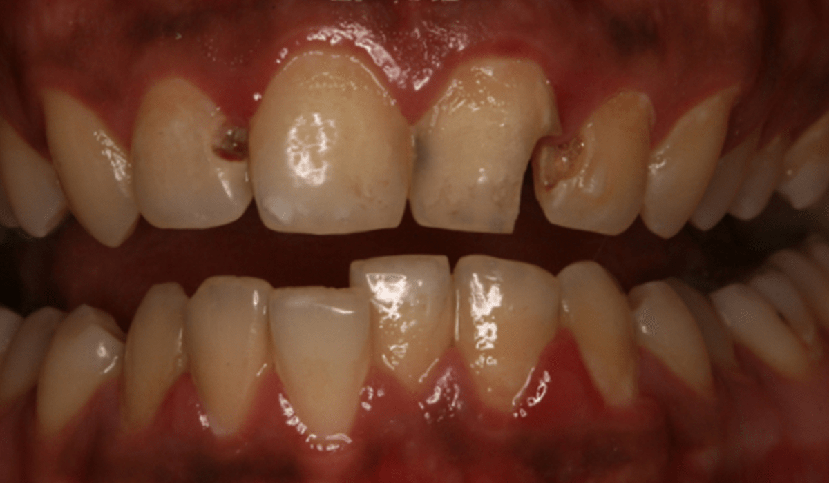 Tooth-Colored-composite-fillings